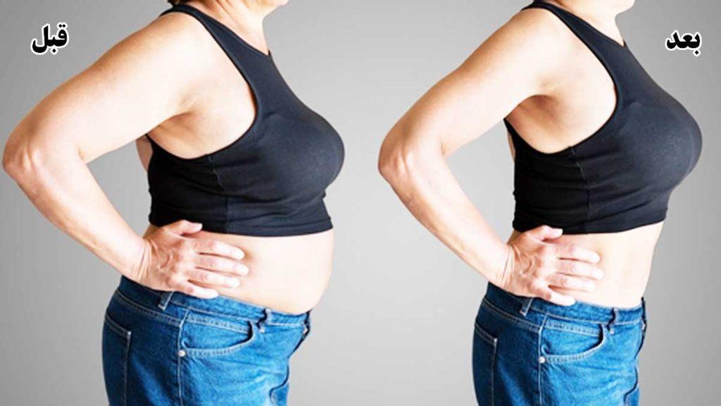 تصویر حاوی عکس دو خانم است که کاهش وزن شکم و پهلو را قبل و بعد از امبدینگ یا کاشت نخ نشان می دهد