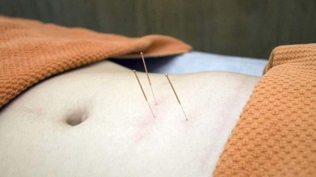 تاثیر لاغری با امبدینگ و طب سوزنی شکم یک بیمار که سه سوزن طب سوزنی در آن فرو رفته است واشاره به تاثیر بیشتر لاغری با امبدینگ در بعضی افراد دارد