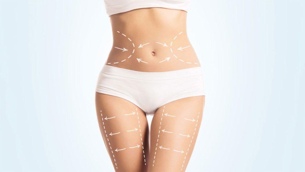 خطوط مشخص شده بر روی بدن یک خانم که به کاربرد مزو امبدینگ لاغری اشاره دارد