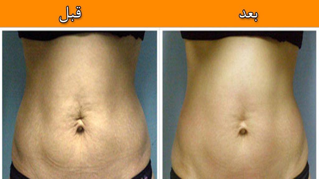 قبل و بعد امبدینگ و مزو امبدینگ لاغری تصویر قبل و بعد امبدینگ و مزو امبدینگ لاغری را نشان می دهد که یک شکم بزرگ و دارای چین و چروک به شکمی کوچک و فاقد چین و چروک تبدیل شده است