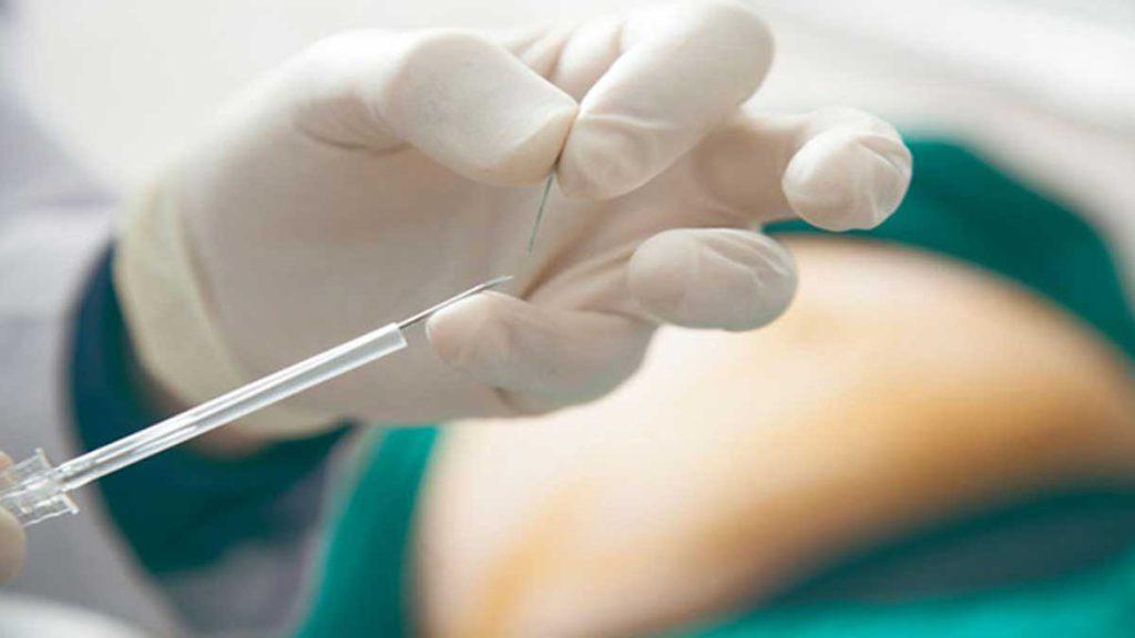 طب سوزنی امبدینگ لاغری و مراقبت های بعد از امبدینگ لاغری شکم و پهلو پزشکی که سوزن و نخ طب سوزنی امبدینگ لاغری در دست دارد و به مراقبت های بعد از امبدینگ لاغری شکم و پهلو اشاره دارد