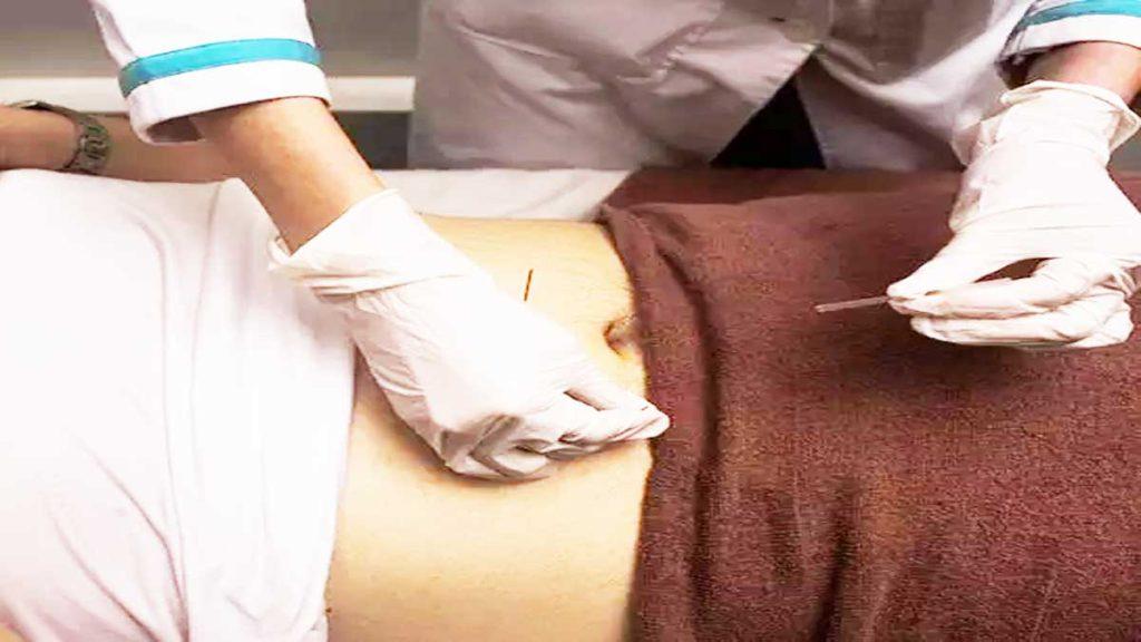 تعداد جلسات امبدینگ و مزو امبدینگ لاغری یک پزشک که در حال فرو کردن سوزن مزو امبدینگ در شکم بیمار است و به تعداد جلسات امبدینگ و مزو امبدینگ لاغری اشاره دارد