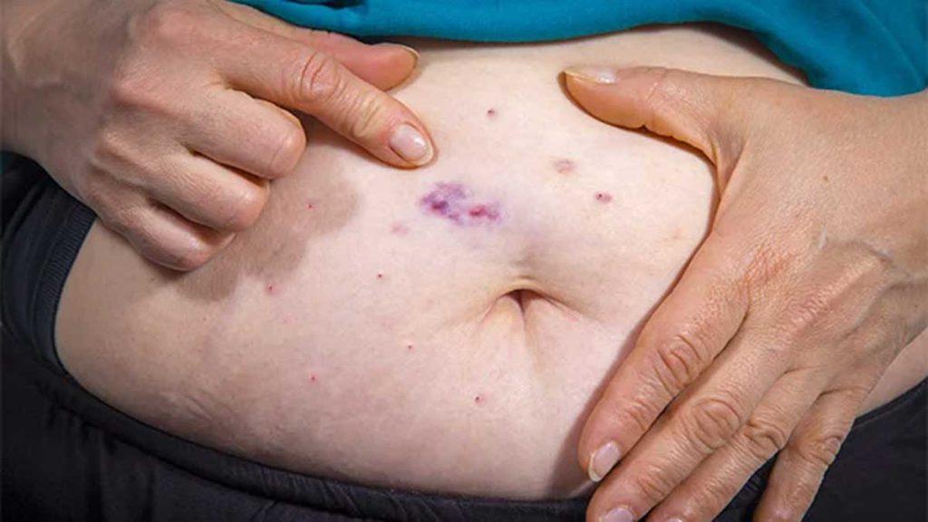 یک خانم که کبودی را بر روی شکم خود نشان می دهد و به عوارض امبدینگ شکم مزو امبدینگ لاغری اشاره دارد