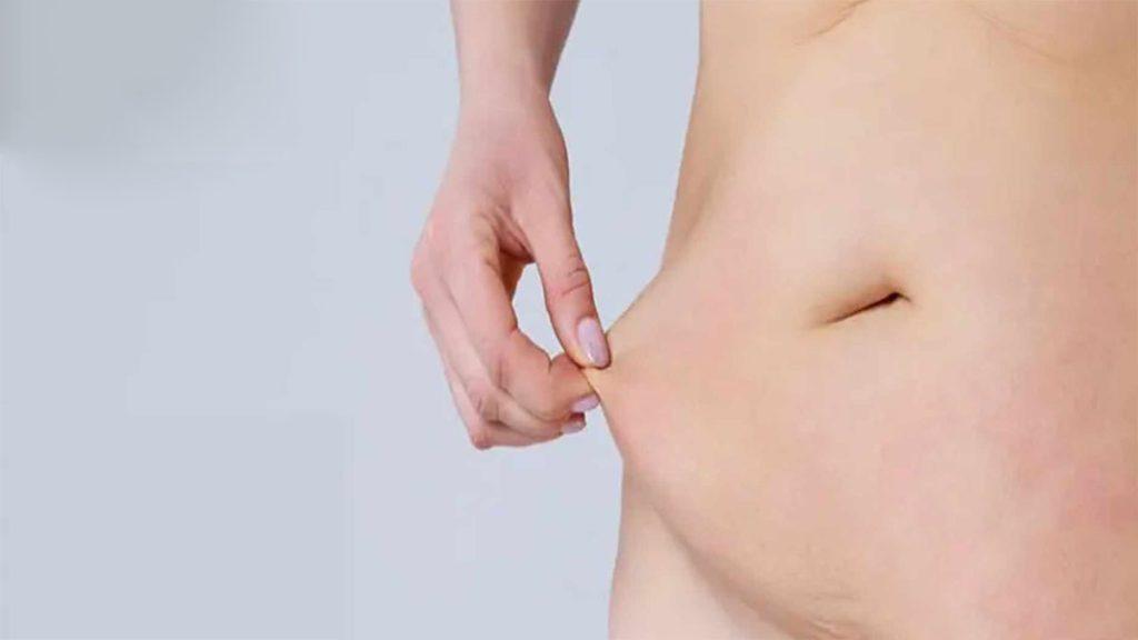 یک خانم که پوست شکم خود را با دست کشیده است و اشاره به تاثیر بیشتر امبدینگ نخ لاغری در کاهش چربی زیر پوستی دارد 