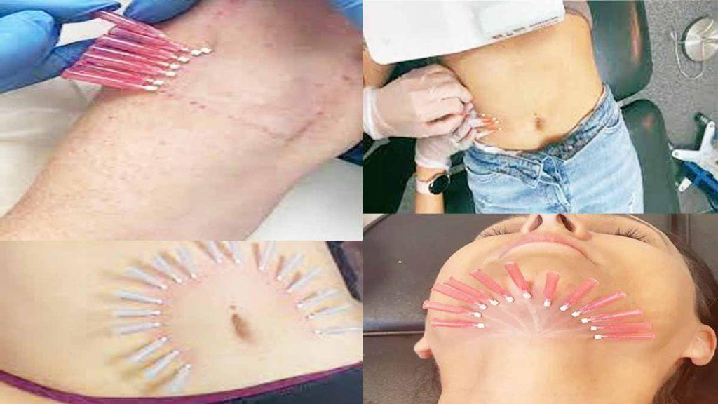 طب سوزنی امبدینگ لاغری و قیمت امبدینگ شکم در تهران 1402 تصویر چند خانم که در نواحی مختلف بدن خود طب سوزنی امبدینگ لاغری انجام داده اند و به قیمت امبدینگ شکم در تهران 1402 اشاره دارد