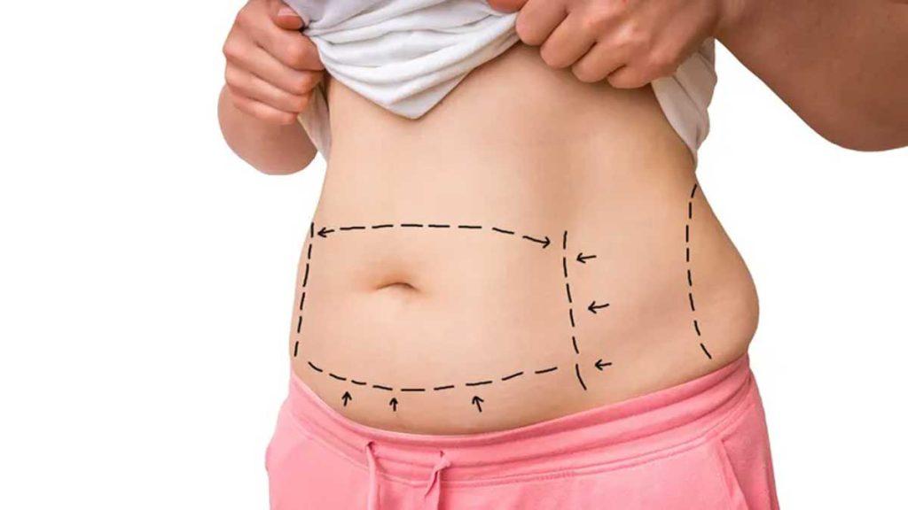 خطوطی که برای انجام امبدینگ روی شکم و پهلو یک خانم کشیده شده است و به تاثیر بیشتر درمان چاقی با طب سوزنی امبدینگ لاغری اشاره دارد
