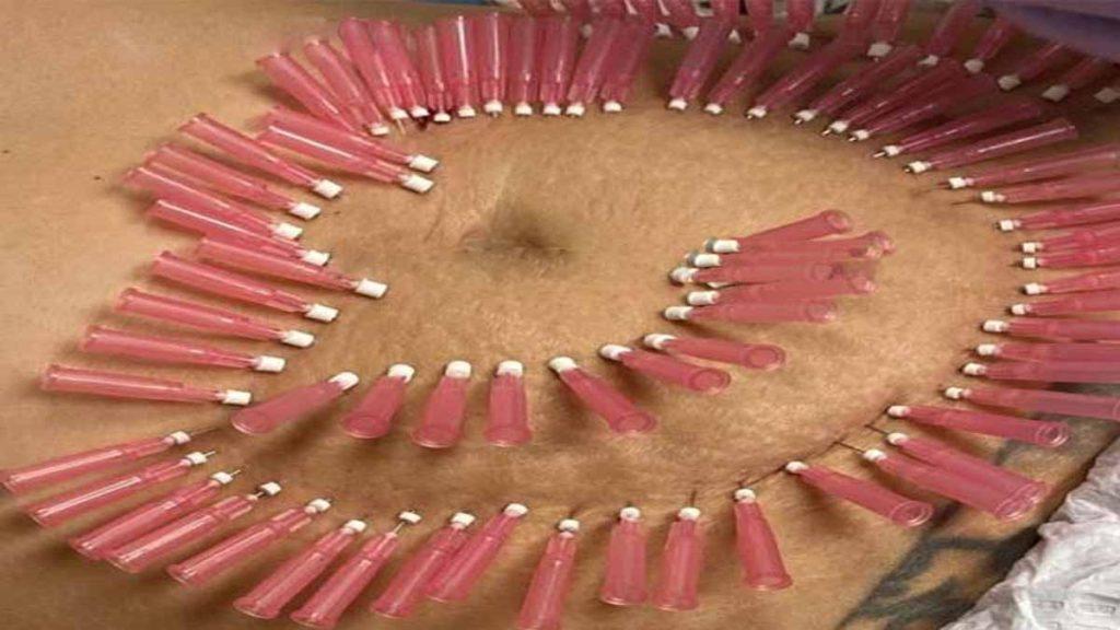 مزو امبدینگ لاغری (مزوتراپی+امبدینگ) چیست؟ سوزن های فرو رفته در شکم که به مزو امبدینگ لاغری چیست اشاره دارد