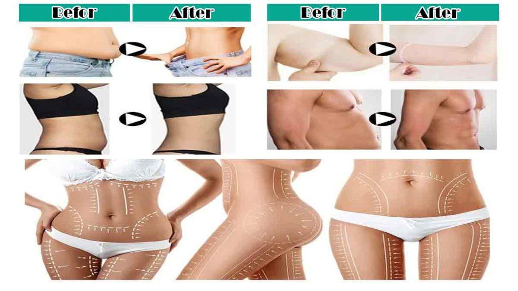 نخ انداختن شکم برای لاغری و مراقبتهای قبل و بعد امبدینگ کاشت نخ لاغری کاهش وزن شکم و بازو با نخ انداختن شکم برای لاغری که به مراقبتهای قبل و بعد امبدینگ کاشت نخ لاغری اشاره دارد