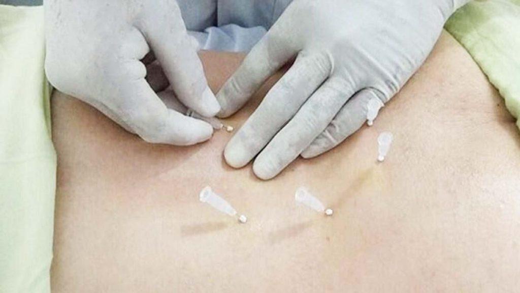 کاربردهای نخ انداختن شکم برای لاغری در درمان بیماری ها فرو کردن سوزن امبدینگ در پشت بیمار توسط پزشک که به کاربردهای نخ انداختن شکم برای لاغری در درمان بیماری ها اشاره دارد