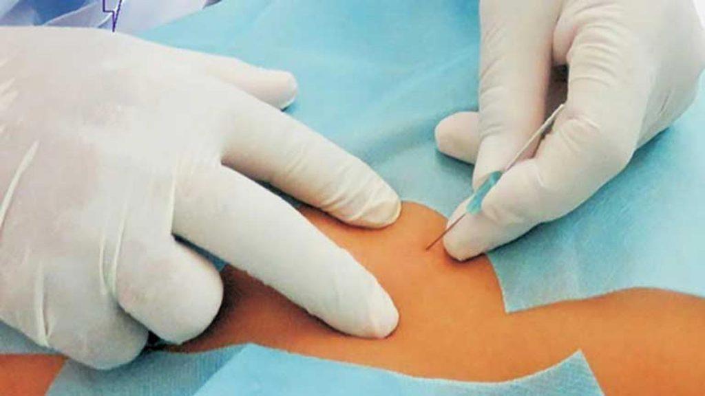 تاثیر تعداد جلسات امبدینگ بر هزینه امبدینگ لاغری فرو کردن سوزن امبدینگ به شکم بیمار توسط پزشک که به تاثیر تعداد جلسات امبدینگ بر هزینه امبدینگ لاغری اشاره دارد