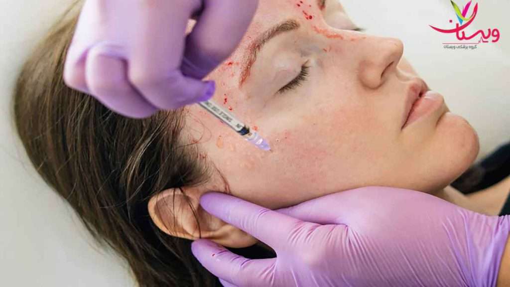 Facial PRP and fat injection پی ار پی صورت و تزریق چربی