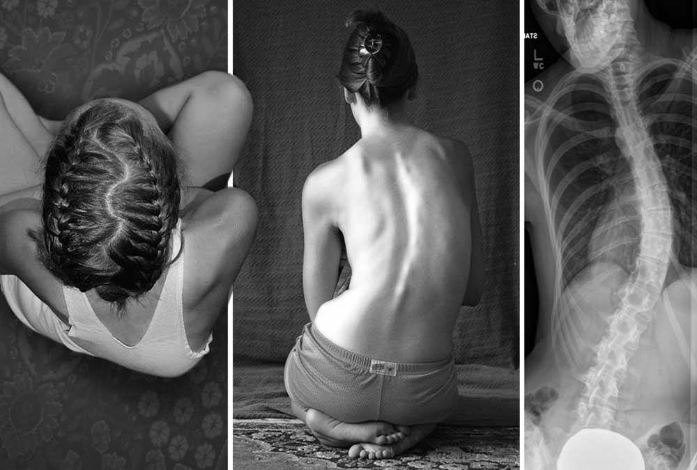 بیماری میوپاتی چیست انواع بیماری میوپاتی