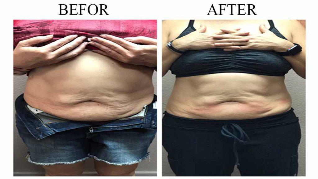 عکس قبل و بعد امبدینگ که شکم بزرگ و شکم کوچک شده یک خانم را بعد از انجام روش درمانی امبدینگ نشان می دهد که به مراقبتهای قبل و بعد امبدینگ لاغری با نخ اشاره دارد