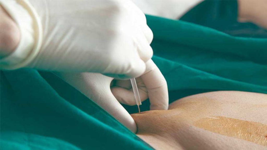 متخصص طب فیزیکی و توانبخشی در غرب تهران-رفع چاقی موضعی و کاشت نخ لاغری امبدینگ با دکتر متخصص طب فیزیکی در غرب تهران فرو کردن سوزن امبدینگ به شکم بیمار توسط پزشک که به متخصص طب فیزیکی و توانبخشی در غرب تهران و رفع چاقی موضعی و کاشت نخ لاغری امبدینگ با دکتر متخصص طب فیزیکی در غرب تهران اشاره دارد