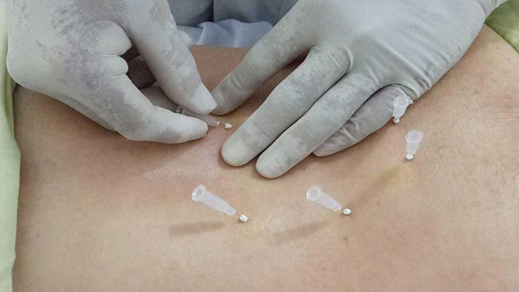 چگونه از عوارض امبدینگ لاغری جلوگیری کنیم؟ فرو کردن سوزن امبدینگ لاغری به پشت یک بیمار توسط متخصص امبدینگ که به چگونه از عوارض امبدینگ لاغری جلوگیری کنیم؟ اشاره دارد