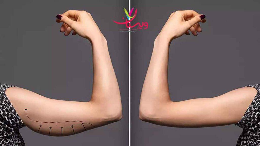لاغری بازو پرسش مردم درباره امبدینگ