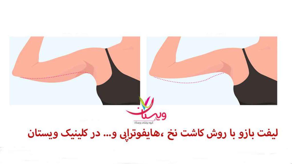 لیفت بازو لیفت بازو