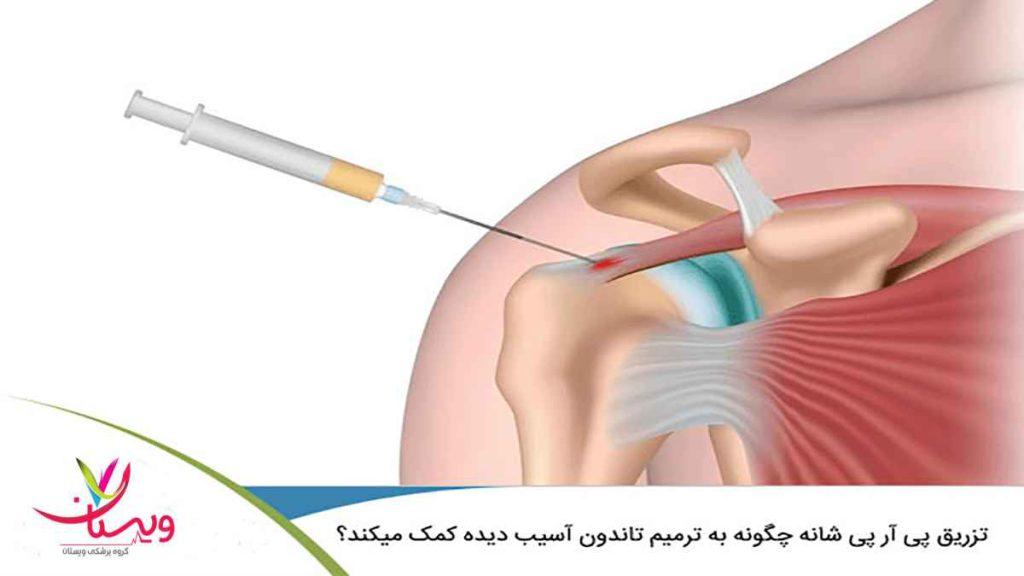 تزریق پی ار پی شانه مزایا پی ار پی