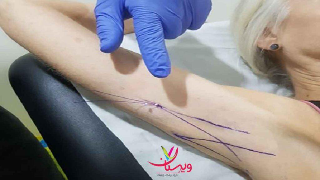 مزایا کاشت نخ مزایای کاشت نخ