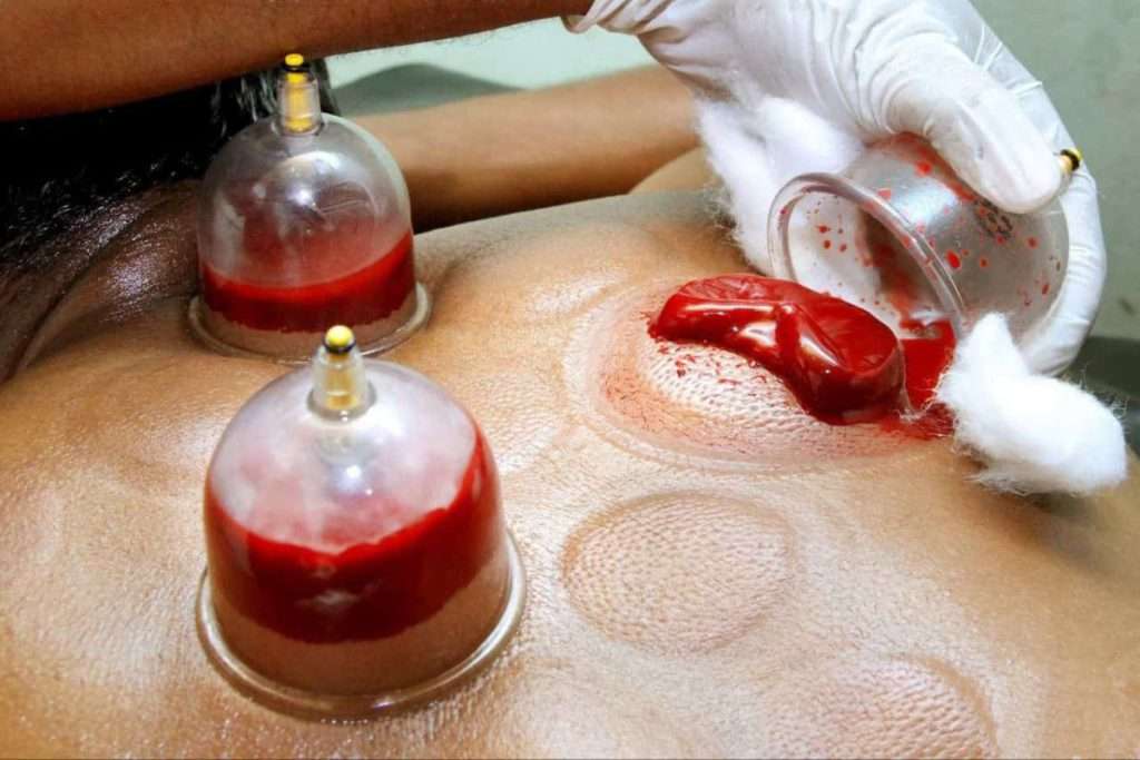حجامت کردن باعث رهایی از زود انزالی می شود