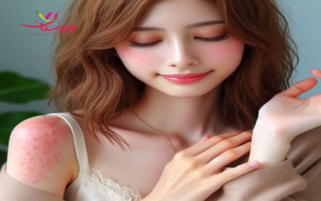 واکنش های آلرژیک با مصرف ناپروکسن