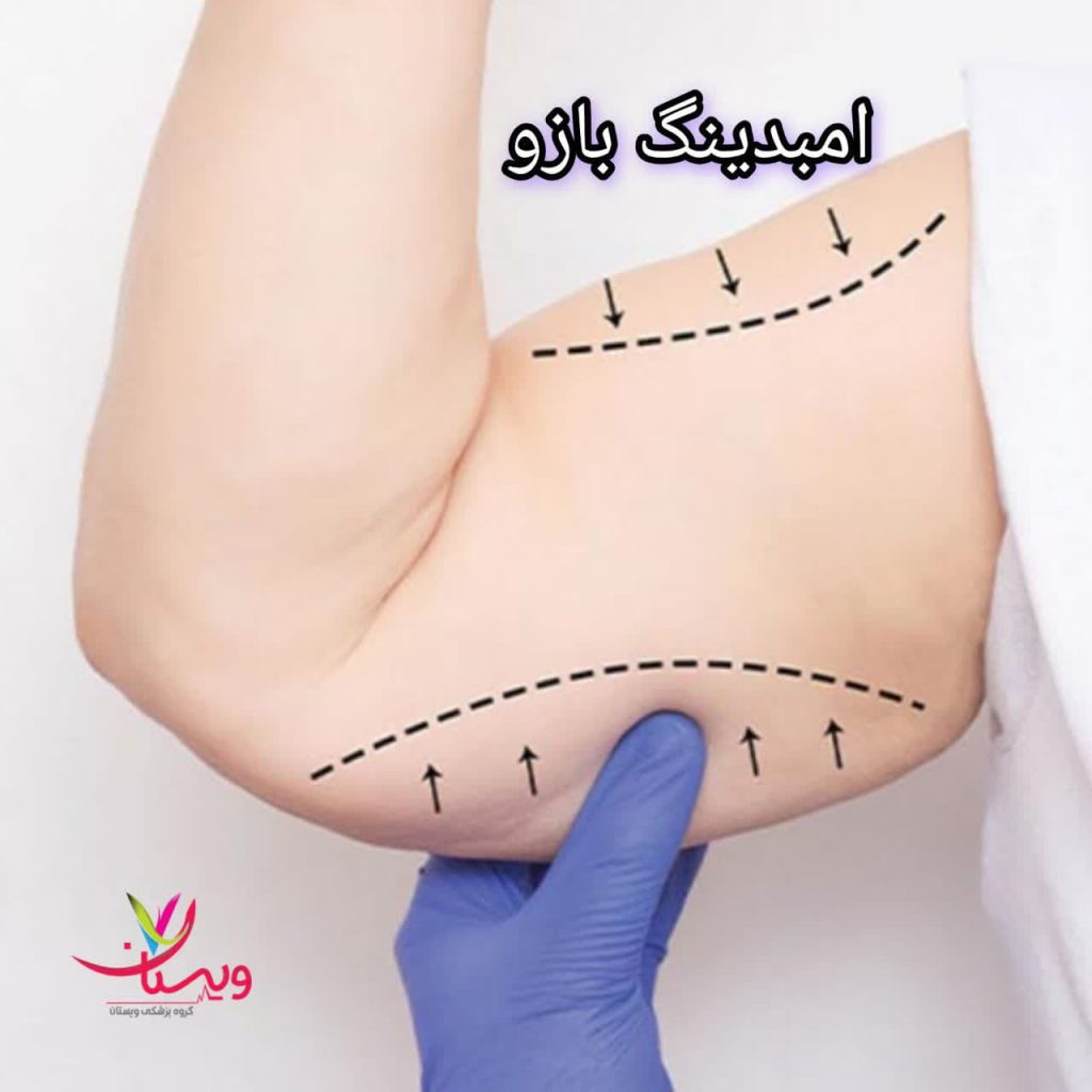 معایب امبدینگ بازو