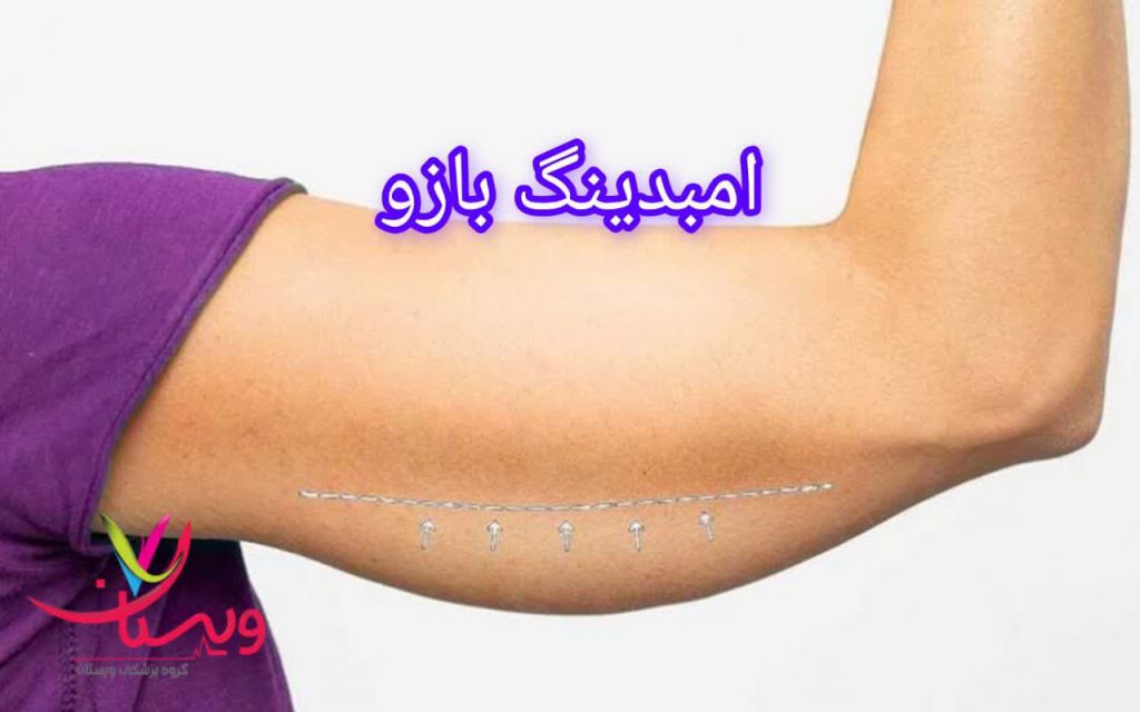 مراحل انجام امبدینگ بازو