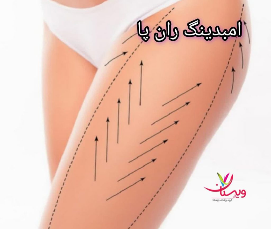 هزینه امبدینگ ران پا