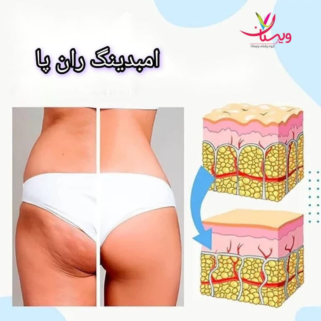لاغری موضعی ران پا با کاشت نخ