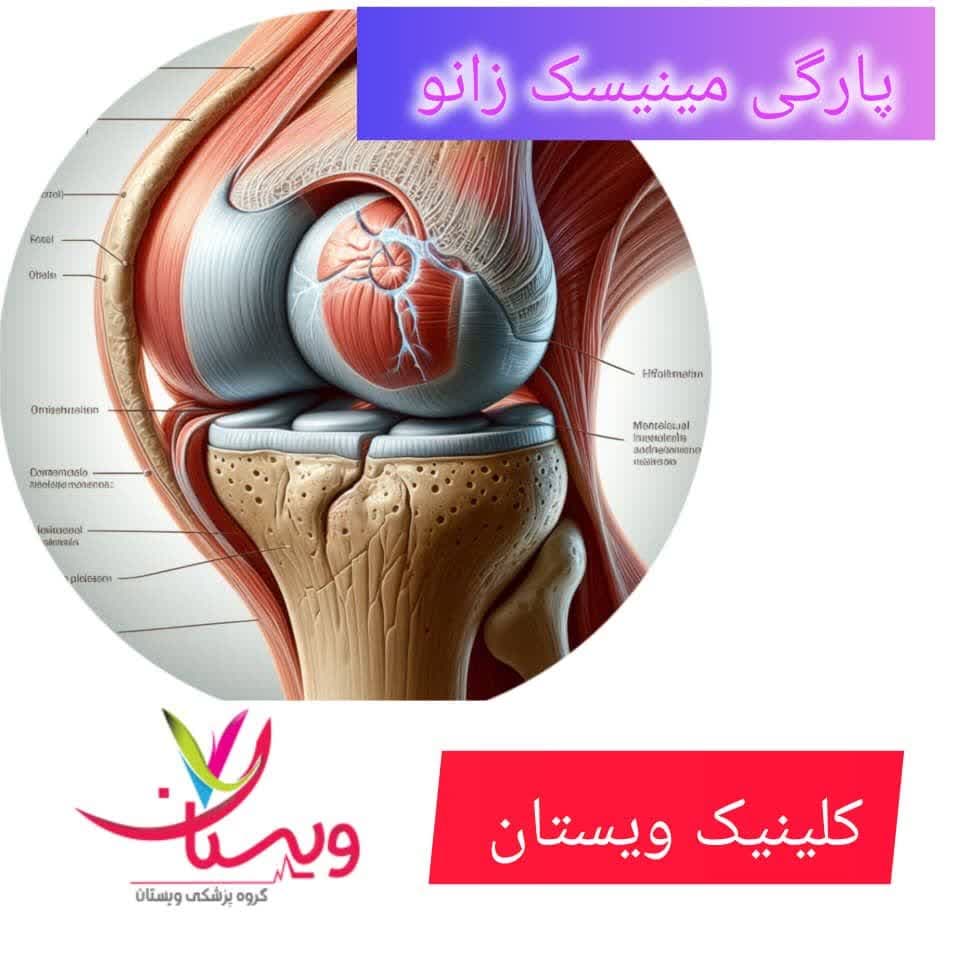 عکس پارگی مینیسک زانو