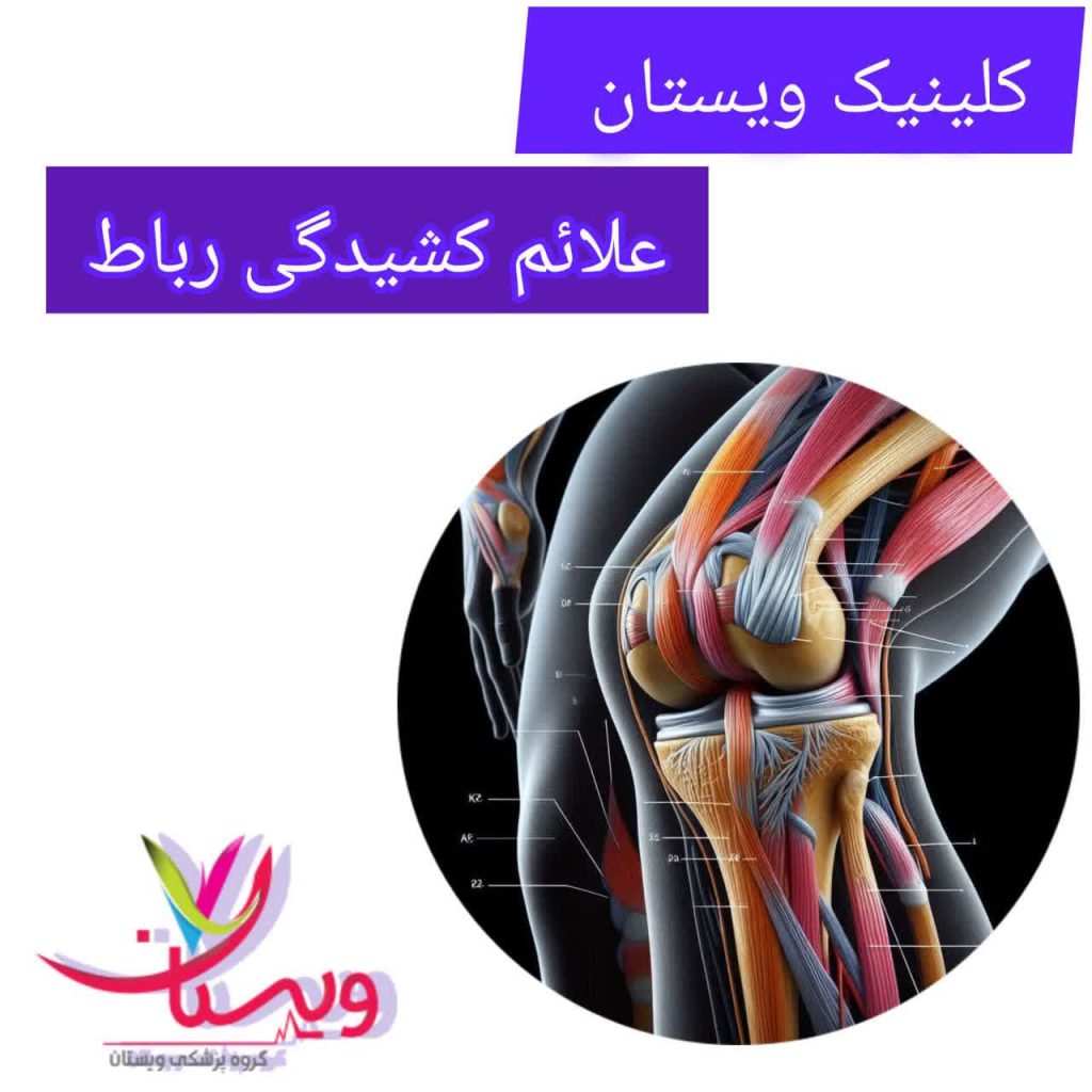 علائم کشیدگی رباط