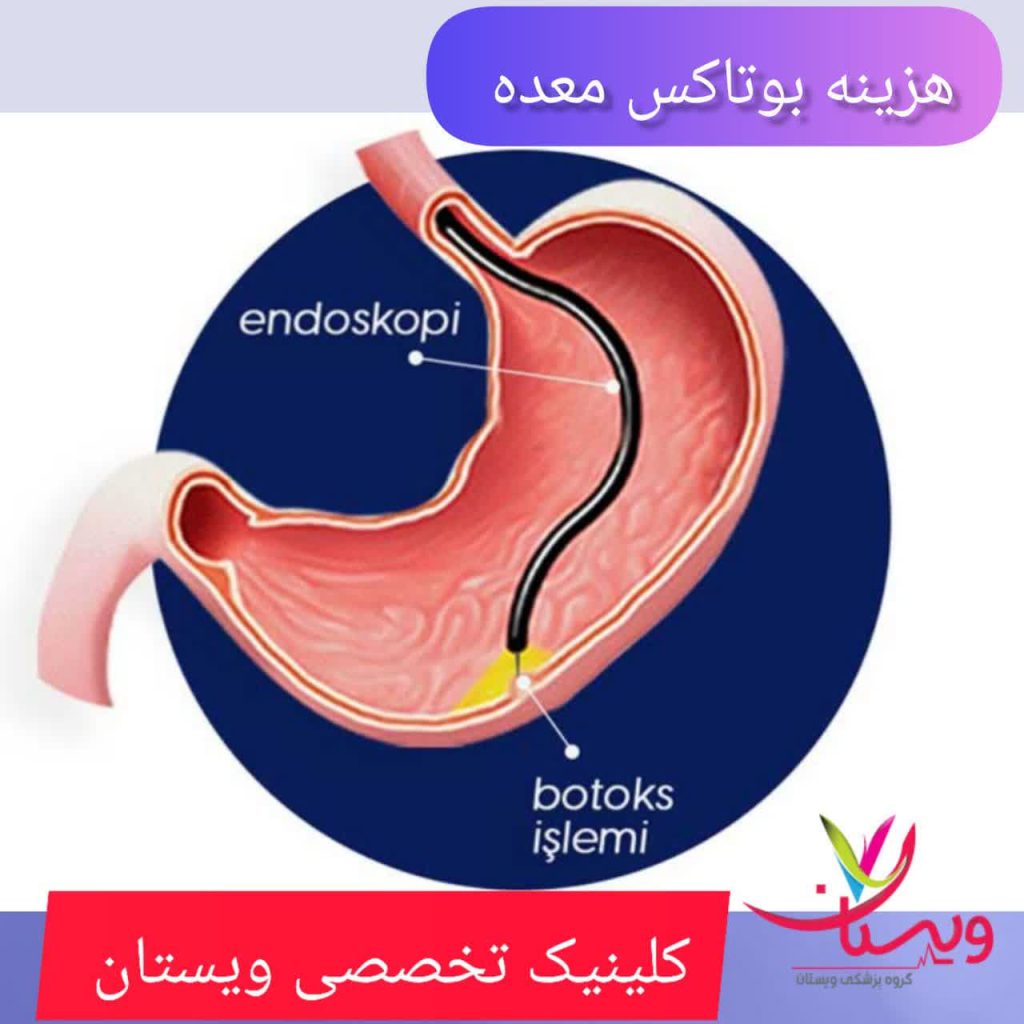 هزینه بوتاکس معده هزینه بوتاکس معده