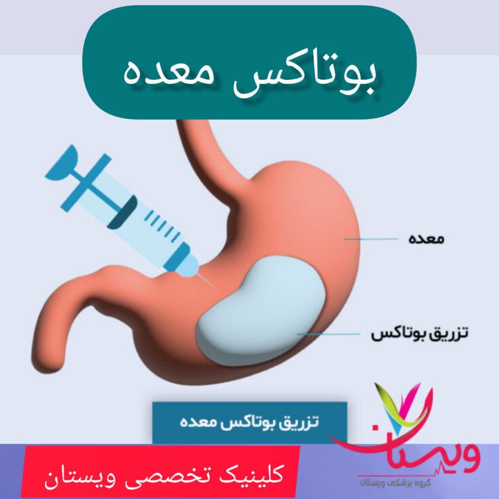 بوتاکس معده بوتاکس معده