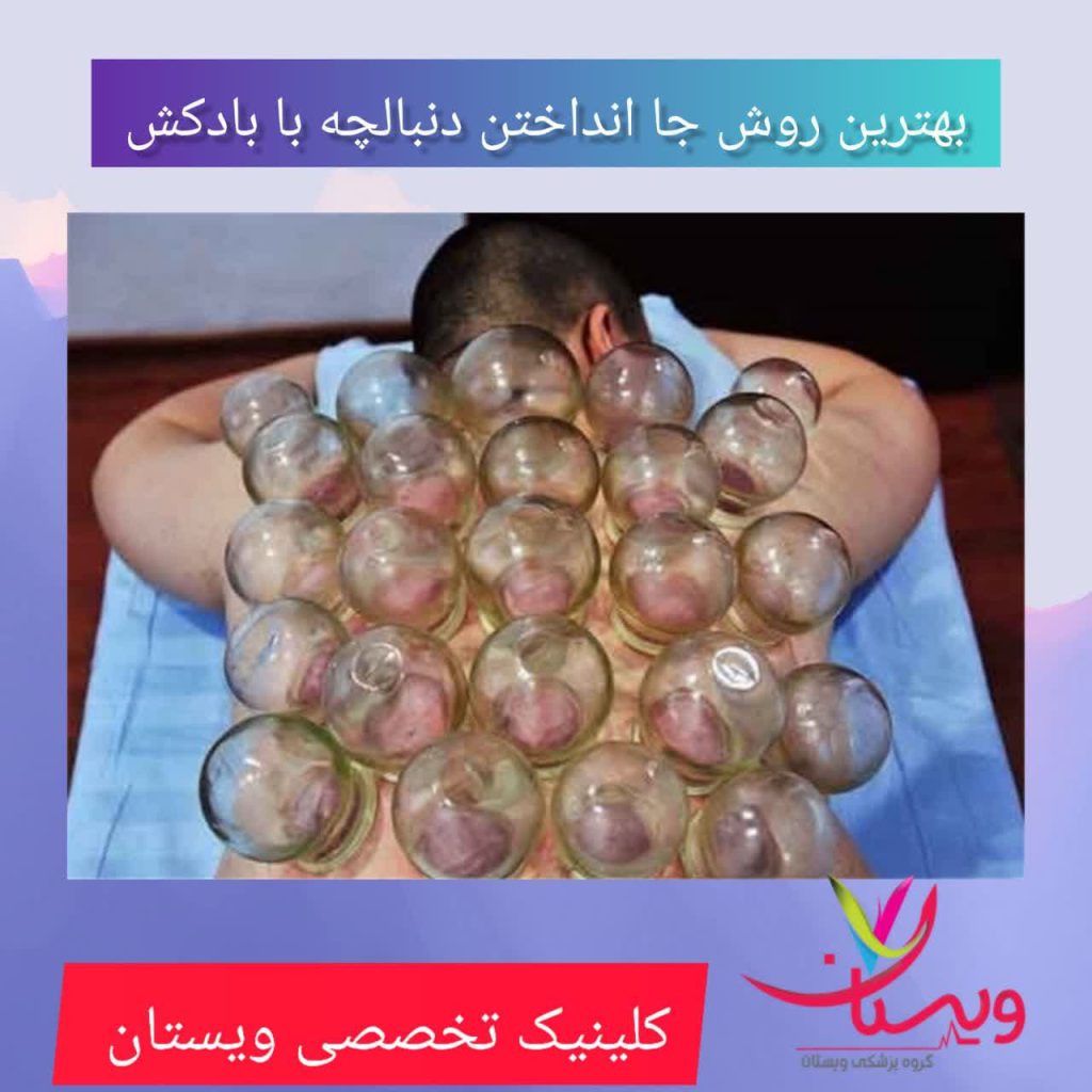 بهترین روش جا انداختن با دست با بادکش بهترین روش جا انداختن با دست با بادکش