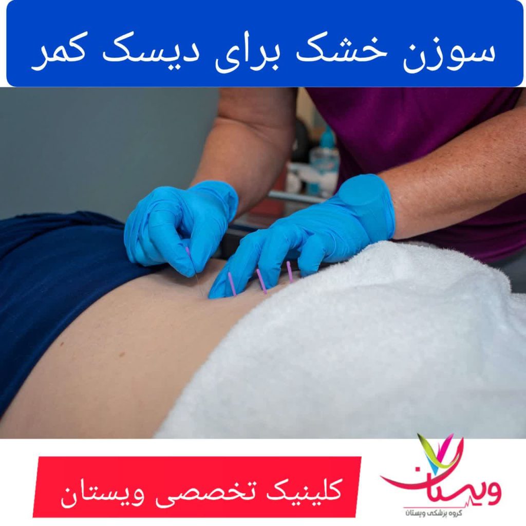 سوزن خشک برای دیسک کمر سوزن خشک برای دیسک کمر