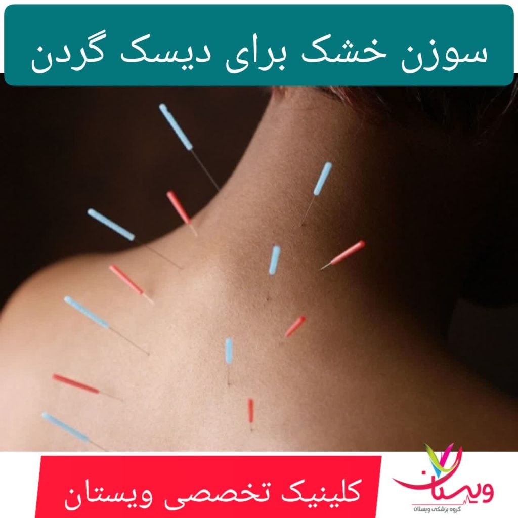 سوزن خشک برای دیسک گردن سوزن خشک برای دیسک گردن