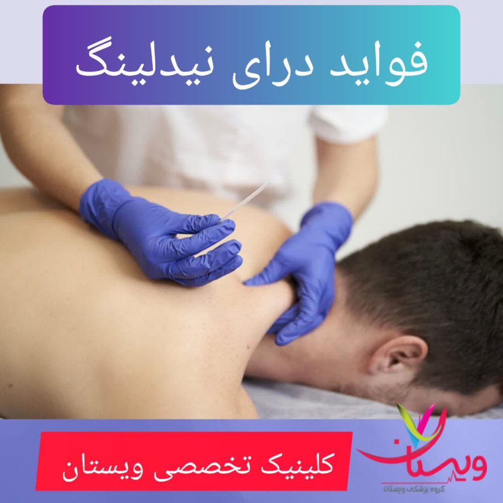 فواید درای نیدلینگ فواید درای نیدلینگ
