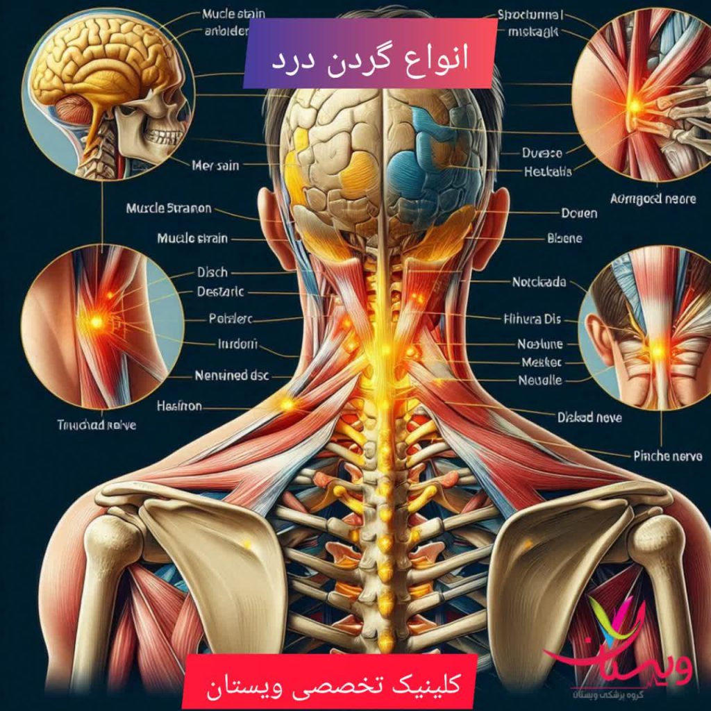 انواع گردن درد انواع گردن درد