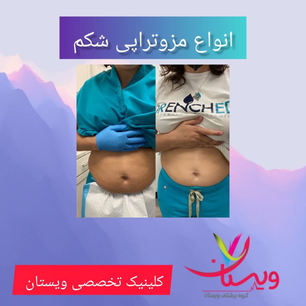 انواع مزوتراپی شکم انواع مزوتراپی شکم