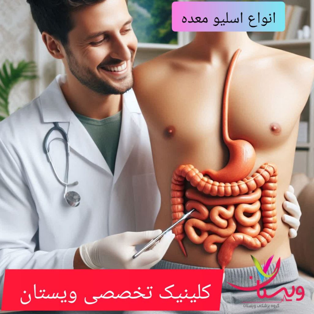 انواع مختلف اسلیو معده انواع مختلف اسلیو معده