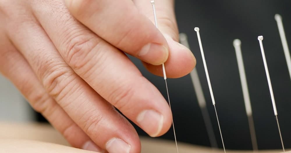 طب سوزنی برای دیسک کمر طب سوزنی برای دیسک کمر