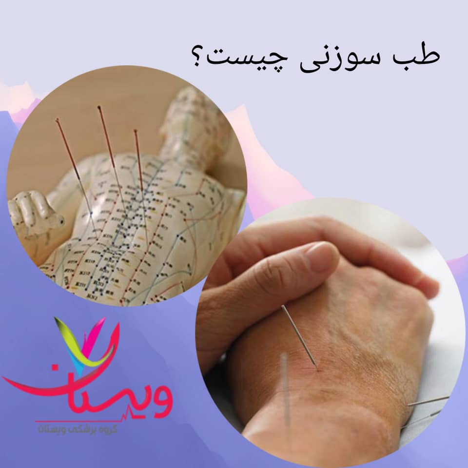 طب سوزنی چیست و چگونه عمل میکند؟ طب سوزنی چیست و چگونه عمل میکند؟