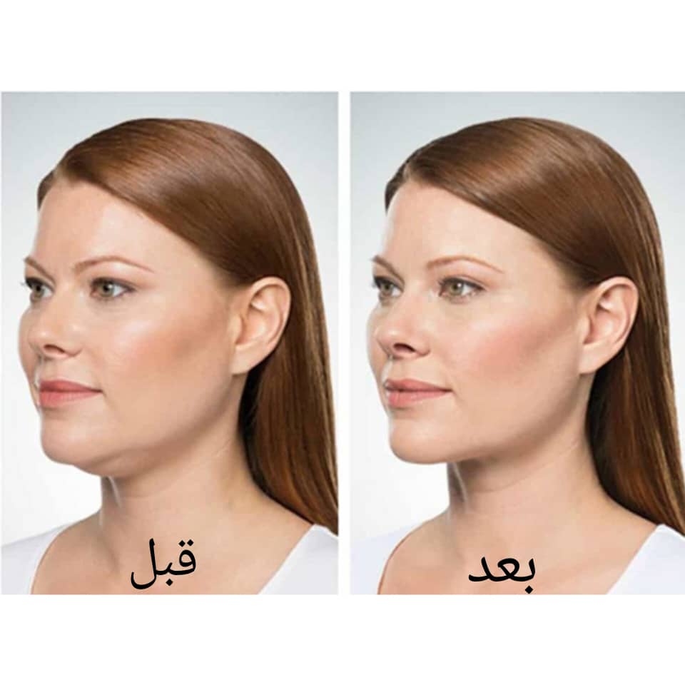 قبل و بعد از لیفت غبغب قبل و بعد از لیفت غبغب