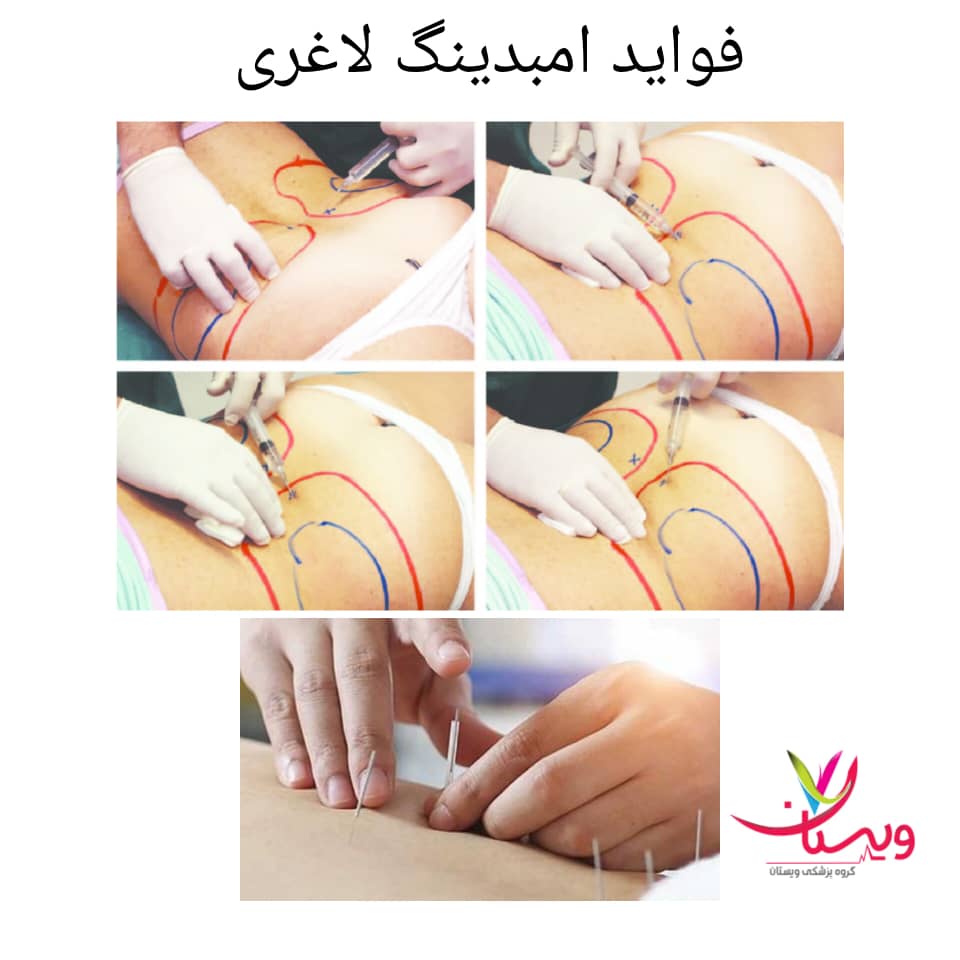 فواید و مزایای امبدینگ لاغری