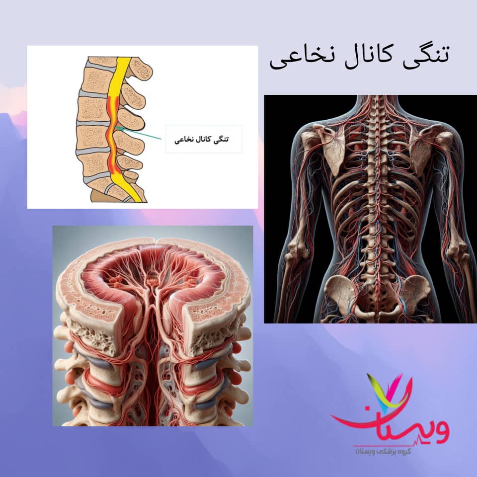 تنگی کانال نخاع تنگی کانال نخاع