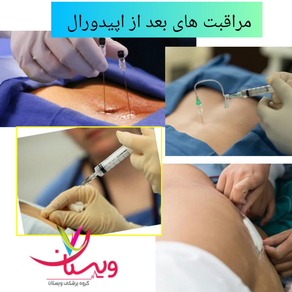مراقبت های بعد از تزریق اپیدورال کمر مراقبت های بعد از تزریق اپیدورال کمر