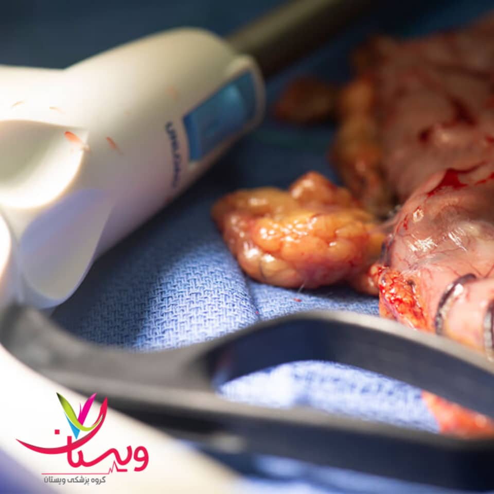 کمترین هزینه جراحی اسلیو معده در کلینیک ویستان کمترین هزینه جراحی اسلیو معده در کلینیک ویستان