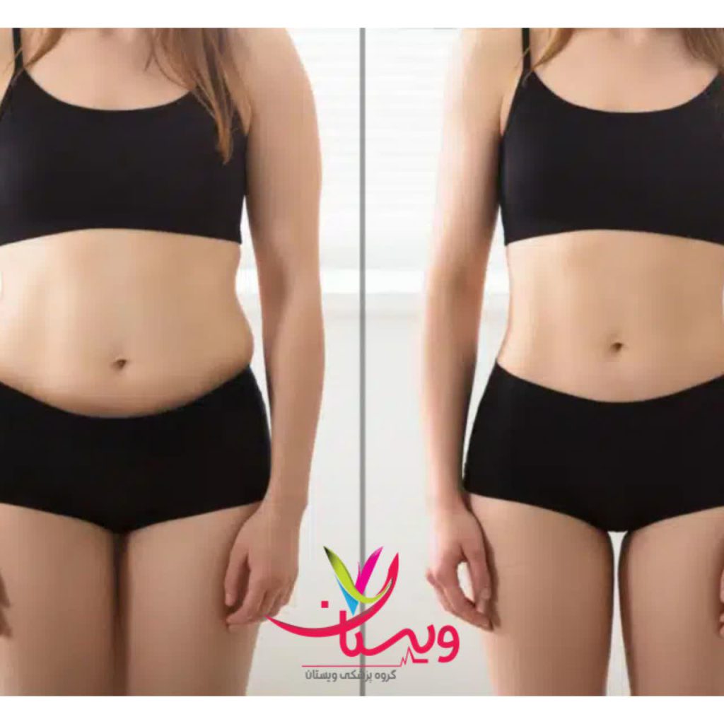 عکس قبل و بعد از تزریق کوکتل فیوژن عکس قبل و بعد از تزریق کوکتل فیوژن