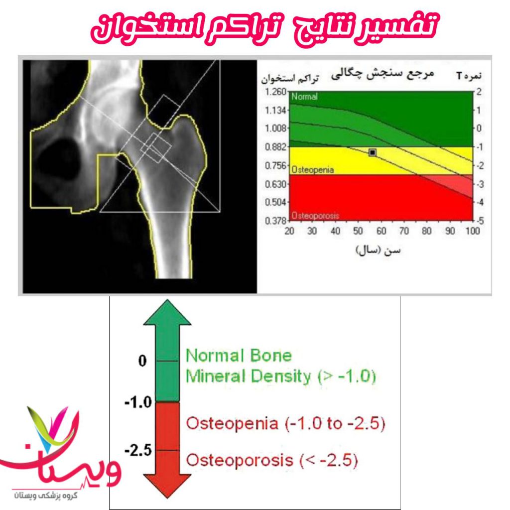 تفسیر جواب اسکن سنجش تراکم استخوان تفسیر جواب اسکن سنجش تراکم استخوان