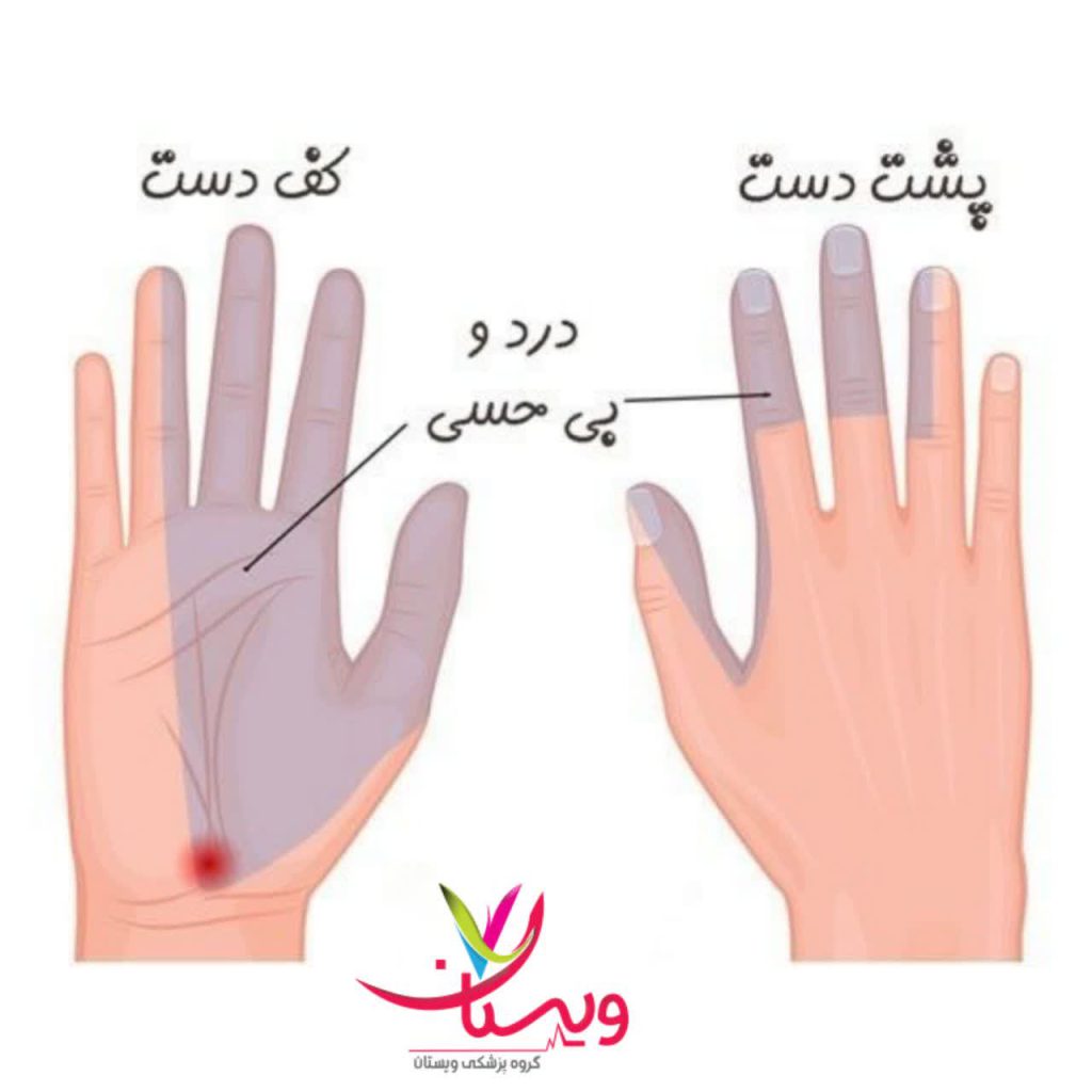 عوارض سندرم تونل کارپال